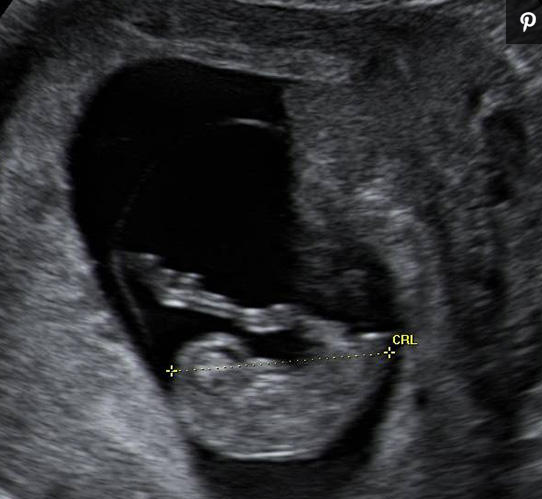 12周婴儿胚胎图片图片
