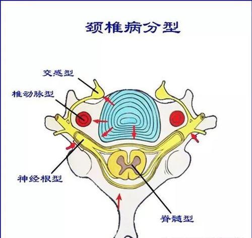 颈椎增生 快懂百科