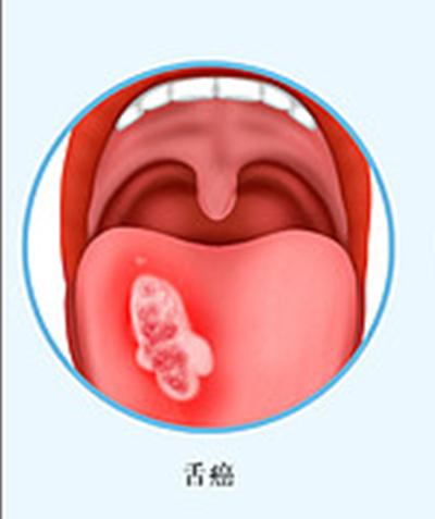 舌癌- 快懂百科