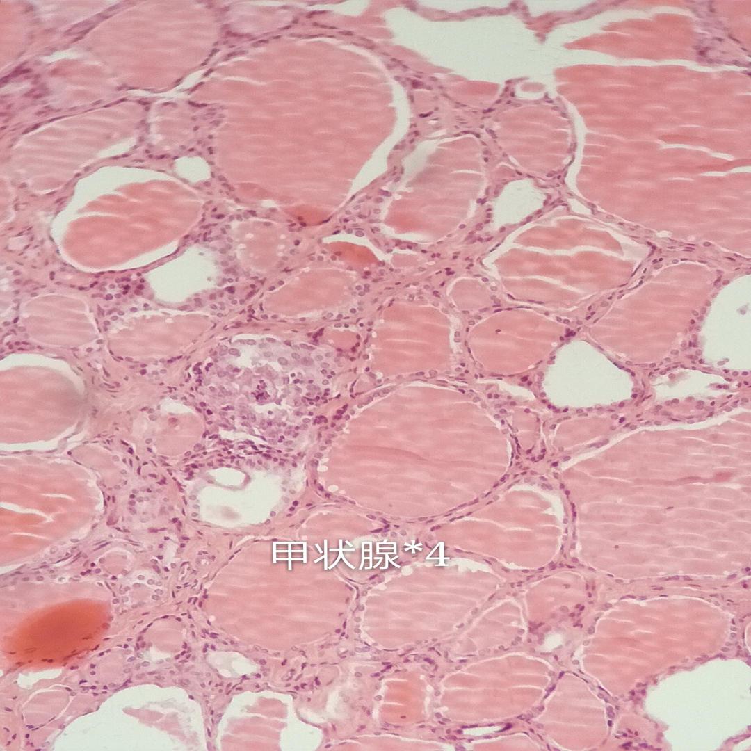 甲状腺腺瘤切片图片
