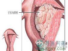 绝经后子宫内膜癌 快懂百科