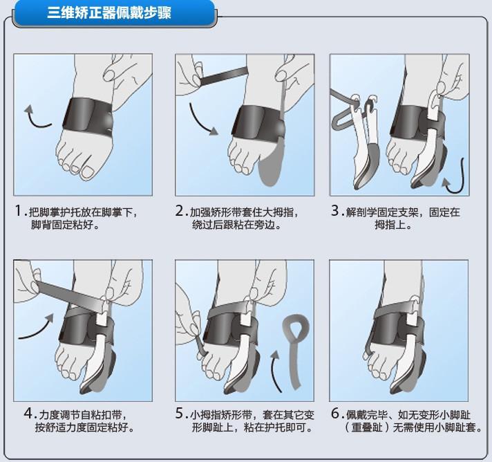 三维压强拇外翻矫正器 - 快懂百科