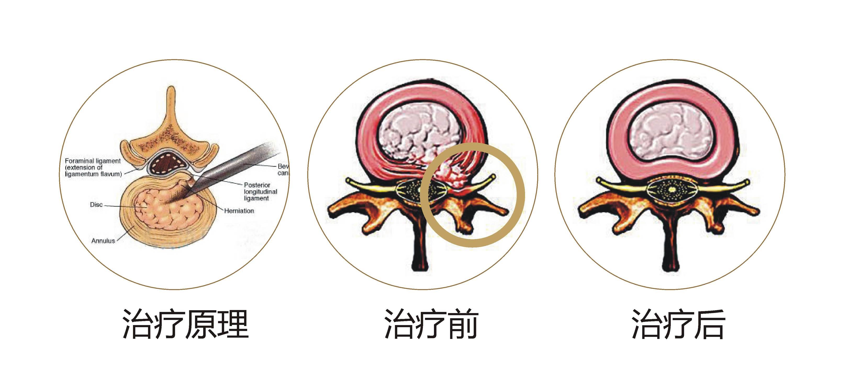 治疗腰椎管狭窄症多见于中老年人,是腰腿疼和下肢行走无力的常见原因.