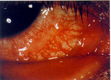 间接型颈动脉海绵窦瘘间接型颈动脉海绵窦瘘可能并发球结膜水肿,眼球