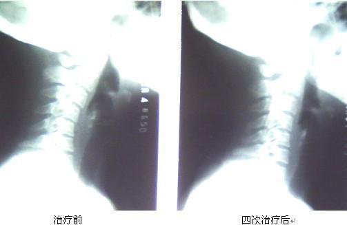 颈椎反弓 成因 相关病症 社会关注 历史版本2 快懂百科