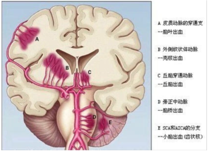 脑淤血 快懂百科