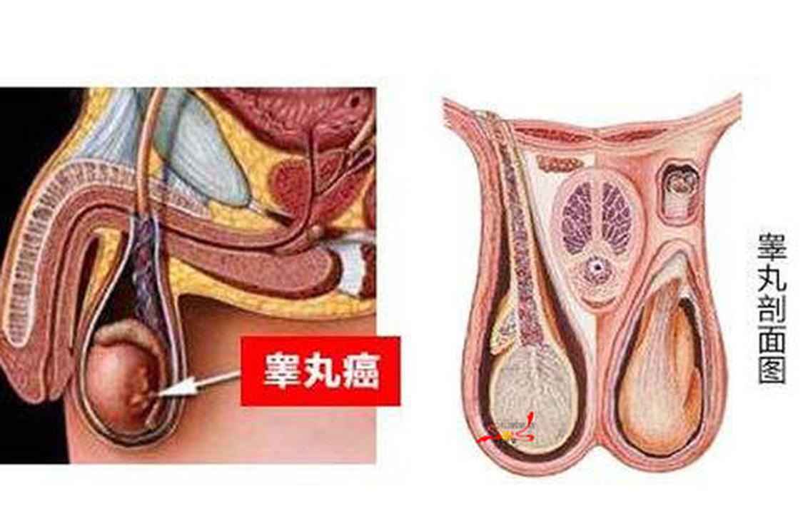 睾丸肿瘤 睾丸肿瘤 头条百科