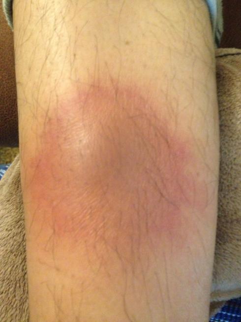 无名肿毒 快懂百科