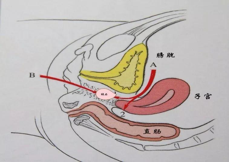 石女