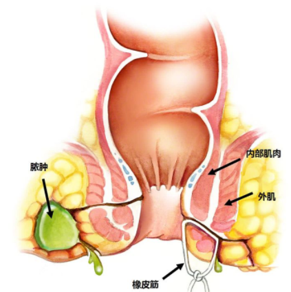 肛瘘全解